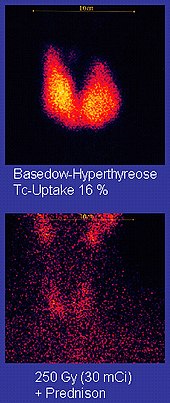 Upper image: two drop-like features merged at their bottoms; they have a yellow centre and a red rim on a black background. Caption: Graves' Disease Tc-Uptake 16%. Lower image: red dots on black background. Caption: 250 Gy (30mCi) + Prednison.
