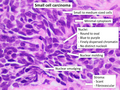 Histopathology of small-cell carcinoma, with typical findings.[127]