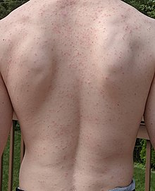 Maculopapular rash from amoxicillin use during EBV infection
