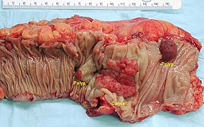 Gross appearance of a colectomy specimen containing two colorectal polyps and one invasive colorectal carcinoma