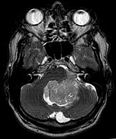 Ependymoma of 4.ventricle in MRI.