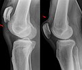 X-ray of a tear of the patellar tendon. On the left: The kneecap is pulled up. On the right: Significant dent in the soft tissue above the kneecap.