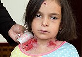 An Iranian girl with EB sores around her neck.