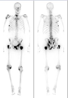 Medical image showing a man's skeleton with several dark spots along the bones.