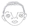 Internasal dysplasia