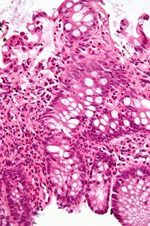 صورة مجهرية تظهر التهاب المعي الغليظ في حالة إصابة بداء الأمعاء الالتهابي. الصورة من خزعة من القولون.