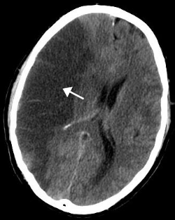 تصوير مقطعي محوسب للدماغ يظهر سكتة دماغية في نصف الكرة الدماغية الأيمن نتيجة نقص التروية.