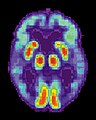 PET scan of brain with AD - Image courtesy of US National Institute on Aging Alzheimer's Disease Education and Referral Center