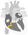 Tricuspid valve marked in yellow.