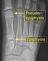 It is common in children to have a pseudo-epiphysis of the first metatarsal.[5]