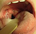 A case of strep throat in a child 8 years of age. Note the large tonsils in the back of the throat, covered in white pus.