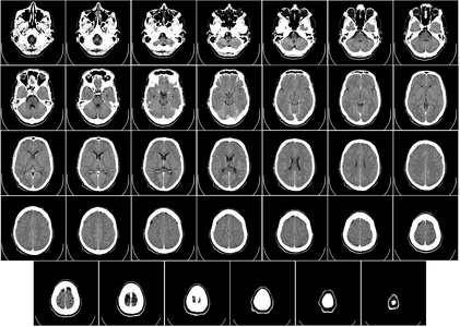 CT scan, by the Department of Radiology, Uppsala University Hospital