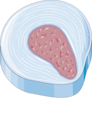 Disc herniation - Prolapse