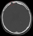 Non-contrast CT scan of the head showing an arachnoid granulation