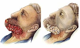 Illustration of a patient with a cancerous growth on his chin.