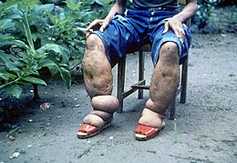 Description de l'image Elephantiasis.jpg.