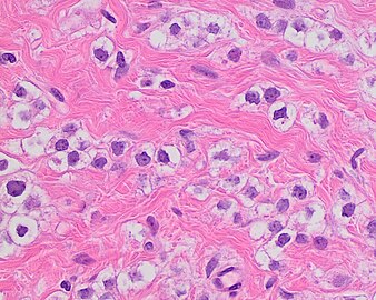 Invasive lobular carcinoma with moderate nuclear pleomorphism.