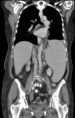 Splenomegalie bei CLL.jpg