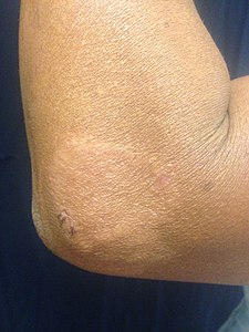 Paucibacillary leprosy (PB): Pale skin patch with loss of sensation