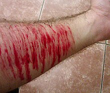 A series of dark red, bleeding wounds on a person's arm