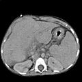 Abdominal CT, showing Morison's pouch as the dark margin surrounding the right kidney (at lower left corner of image)