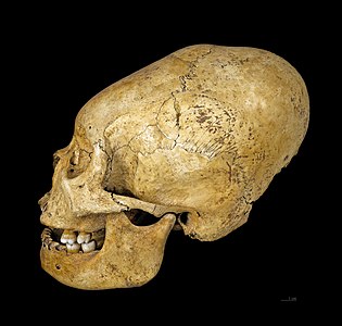 Proto Nazca deformed skull at Artificial cranial deformation, by Archaeodontosaurus