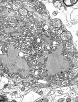 TEM micrograph with numerous rabies virions (small, dark grey, rodlike particles) and Negri bodies (the larger pathognomonic cellular inclusions of rabies infection)