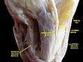 Extrinsic eye muscle. Nerves of orbita. Deep dissection.