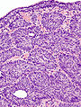 Histopathology representing an inverted papilloma of the urinary bladder that was cystoscopically resected. Hematoxylin and eosion stain.
