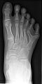 Polydactylic right foot