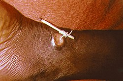 صورة تبين استخدام عود ثقاب لإزالة دودة غينيا من ساق إنسان.