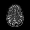 Immagine di risonanza magnetica che mostra piccole alterazioni focali iperintense nelle sequenze pesate in T2 localizzate in sede frontale ed insulare a destra, da riferire a lesioni gliotiche post-ischemiche in un soggetto con emicrania.