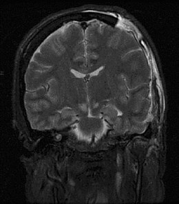 Description de l'image Brain herniation MRI.jpg.