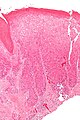 Micrograph of differentiated vulvar intraepithelial neoplasia. H&E stain.