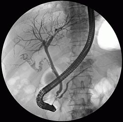 صورة ERCP تظهر قنوات الصفراء وقناة البنكرياس.