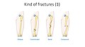 Kind of fractures - Oblique Comminuted Spiral Compound