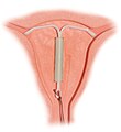 Hormonski intrauterini uložak (spirala) s prikazom položaja nakon uvođenja u uterus