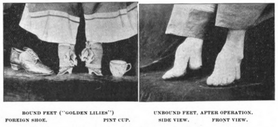 (l-r) Woman's bound feet ("Golden Lilies"). Unbound feet after operation. (1896)