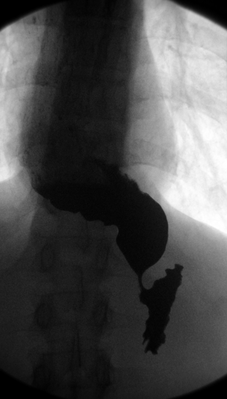 R-контрастный снимок сульфатом бария, видны замедление поступления жидкости в полость желудка через суженный просвет сфинктера и скопление её в расширенном просвете пищевода S-образной формы