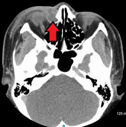 A case of dacryocystitis as seen on تصوير مقطعي محوسب