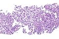 Pneumocytoma - intermed. mag.