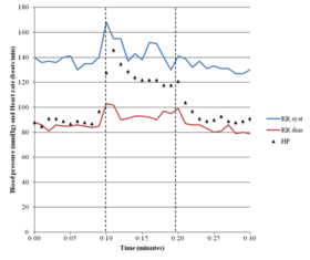 Graph of a patient's heart rate and blood pressure during a tilt table test, showing their heart rate increasing from 85 to 145 when tilted upright