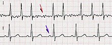 Electrocardiographic image depicting atrial fibrillation