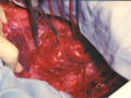 Intraoperative image of aortic coarctation with aneurysmically changed intercostal arteries