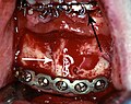 Rigid internal fixation of parasymphysis fracture of the mandible. White arrow marks fracture, black arrow marks arch bar on lower teeth