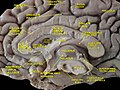 Cerebrum. Medial face. Dissection of corpus callosum etc.