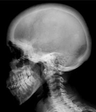 Ground glass density of the skull.[18]