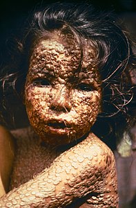 Child with smallpox, by James Hicks (restored by Econt)