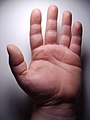 More common palmar creases in adults