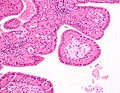 High magnification micrograph of a Warthin tumor showing the characteristic bilayered epithelium.